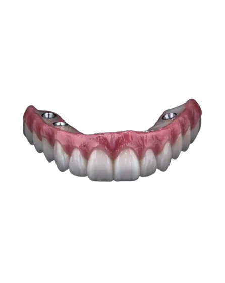 Prótese Protocolo sobre implantes, com estética natural